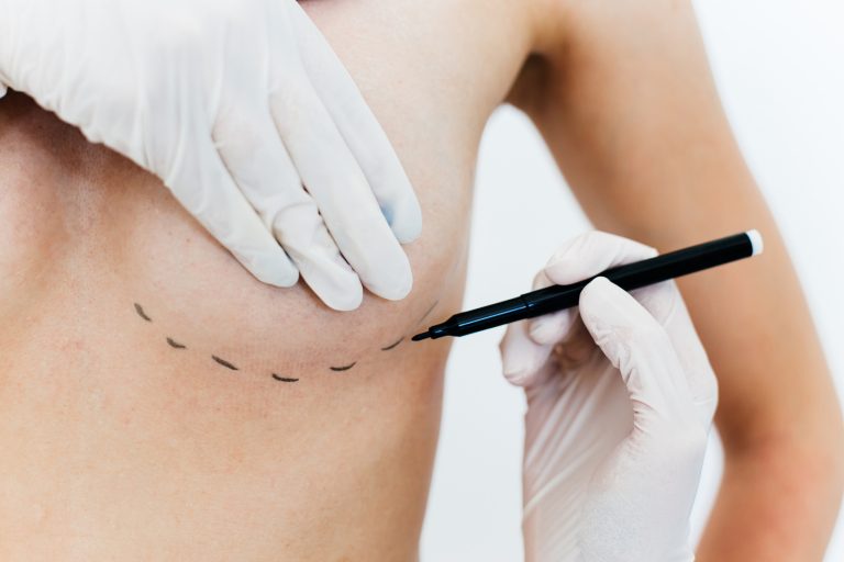 Nova Lei Garante Cirurgia Reparadora de Mama no SUS Independente da Causa da Mutilação